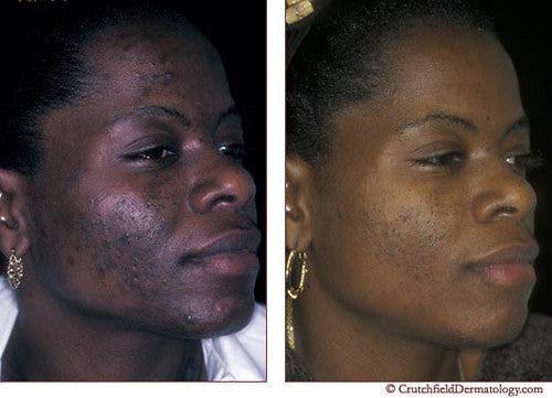 Acne Soap for Pimple and Dark Spot Removal