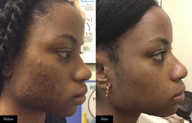 Acne Soap for Pimple and Dark Spot Removal