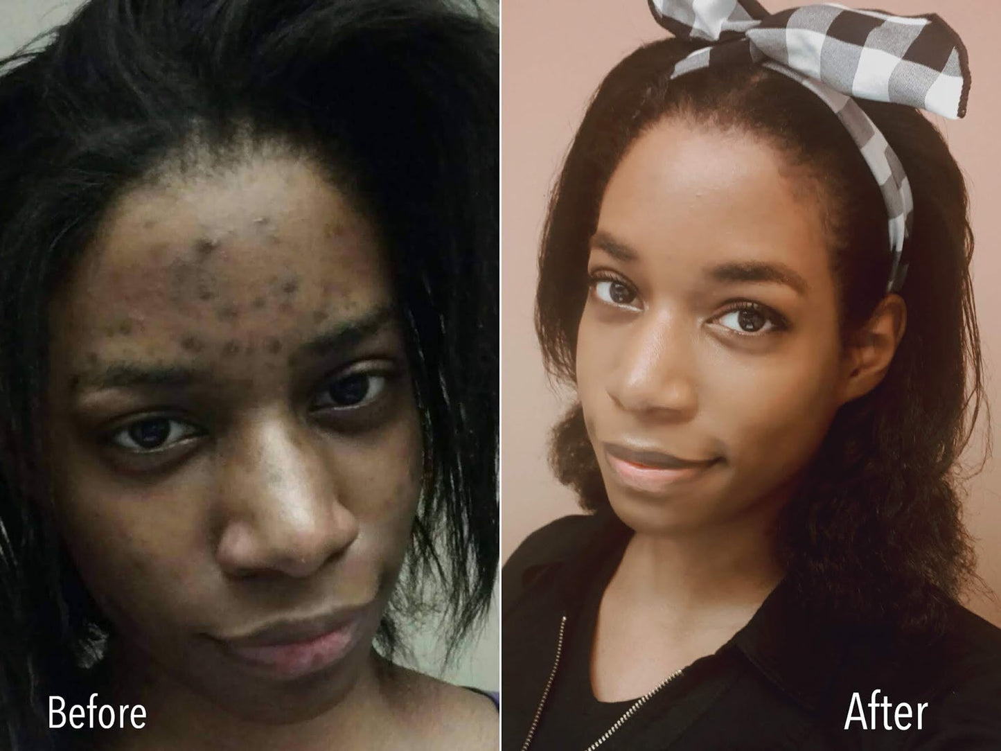 Acne Soap for Pimple and Dark Spot Removal